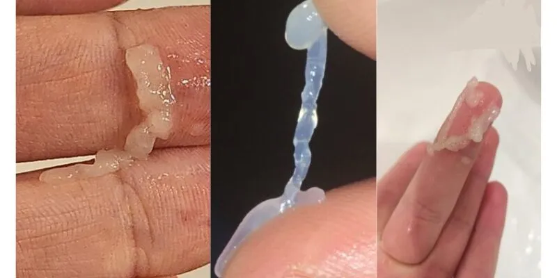 Tinh trùng vón cục là gì?