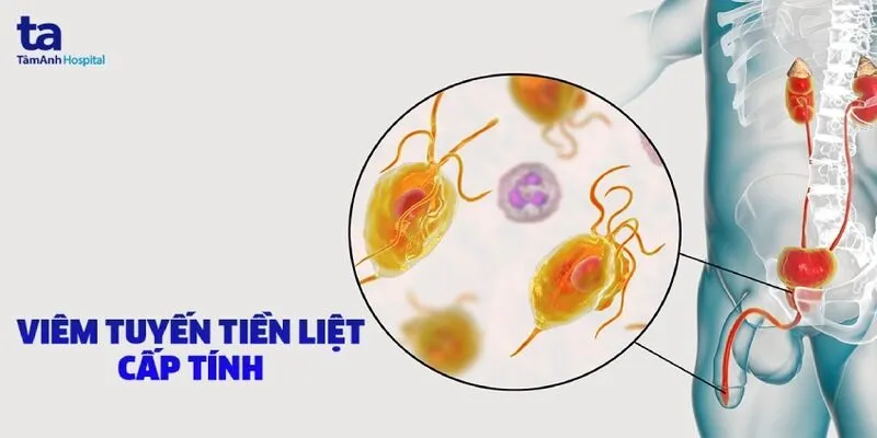 Chế độ ăn uống và sinh hoạt cho người bệnh viêm tuyến tiền liệt mãn tính