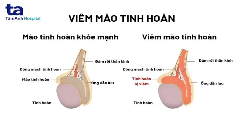 Viêm tinh hoàn là gì?