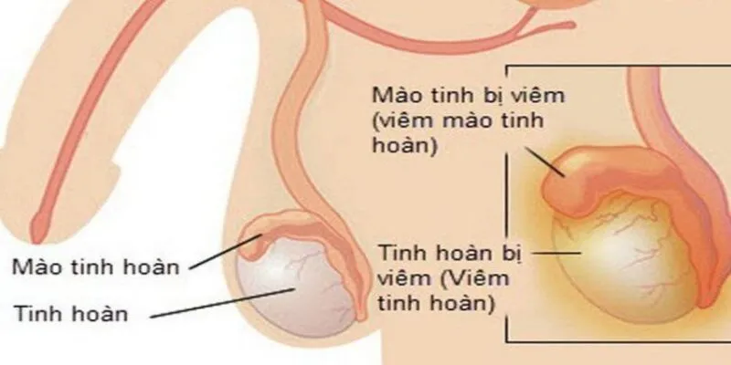 Cách phòng ngừa viêm tinh hoàn