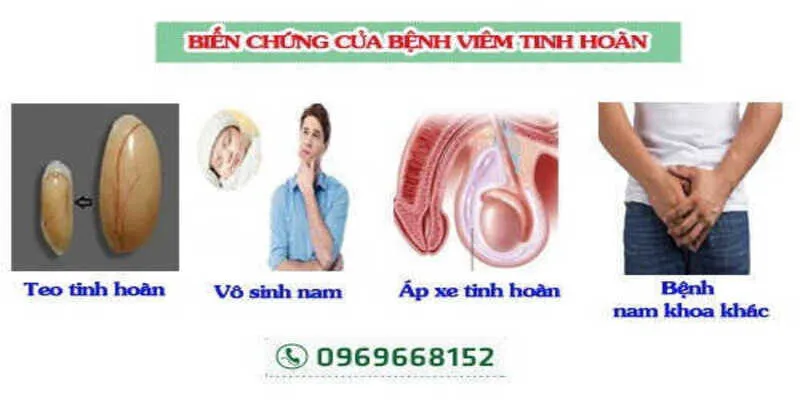 Triệu chứng của viêm tinh hoàn