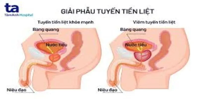 Nguyên nhân gây viêm tuyến tiền liệt