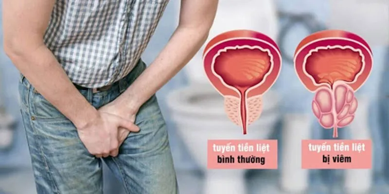 Viêm Tuyến Tiền Liệt: Nguyên Nhân Và Phương Pháp Điều Trị